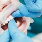 Close up of a Denist's gloved hands working with a retractor on a female patient's mouth.