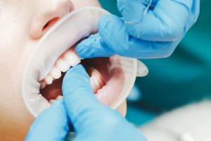 gloved hands of a dentist flossing a young patients mouth that is being held open with a retractor